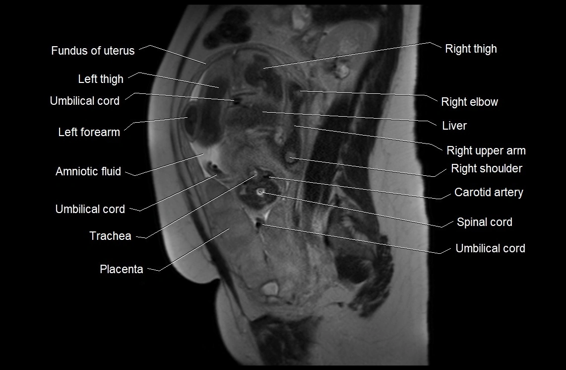 MRI fetal anatomy sagittal image 14.webp